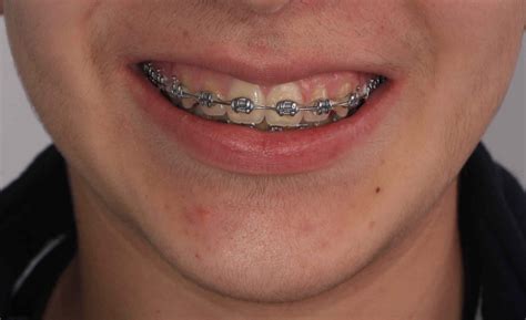 precio ortodoncia brackets metalicos|proceso para poner brackets.